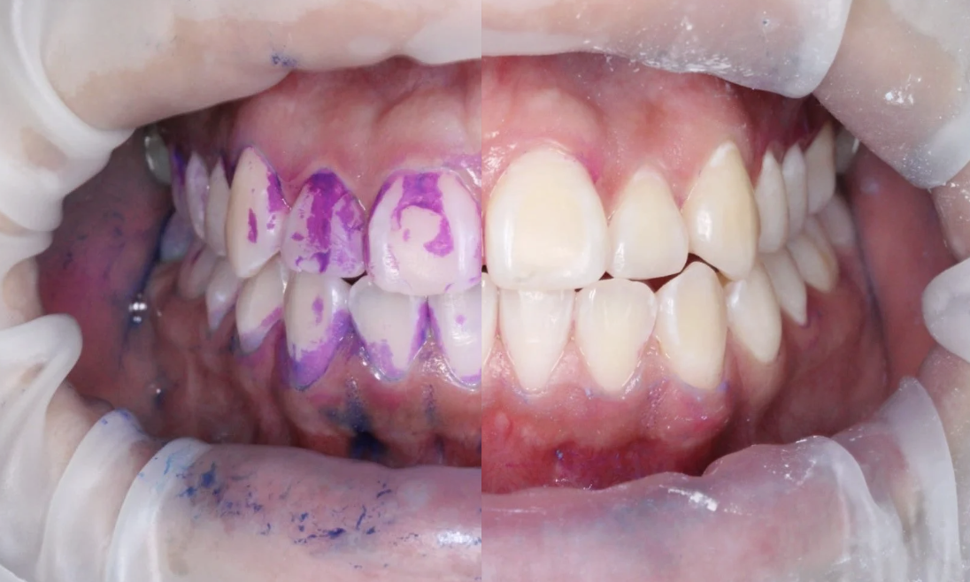 Antes y después de limpieza dental