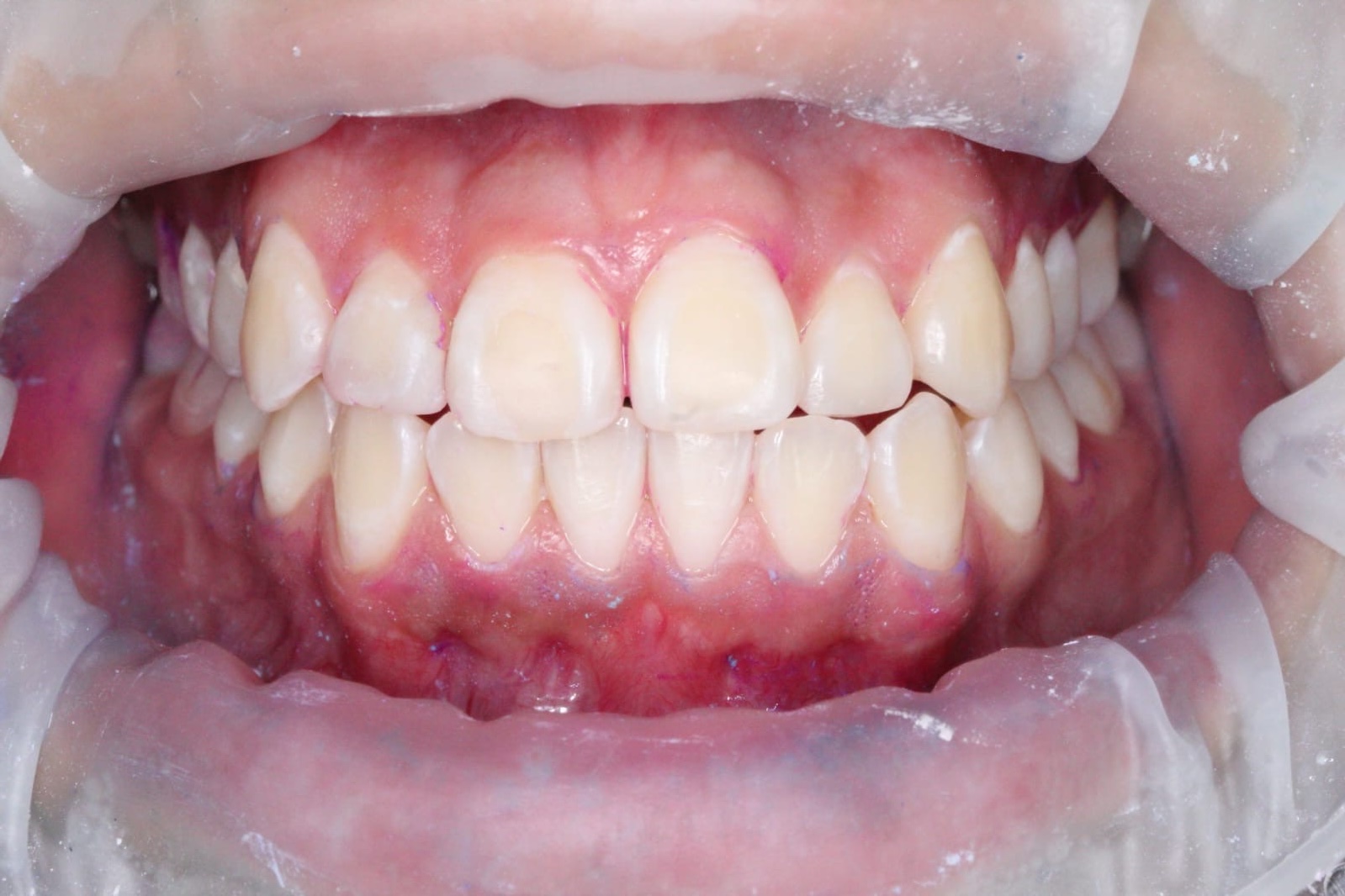 Blanqueamiento dental