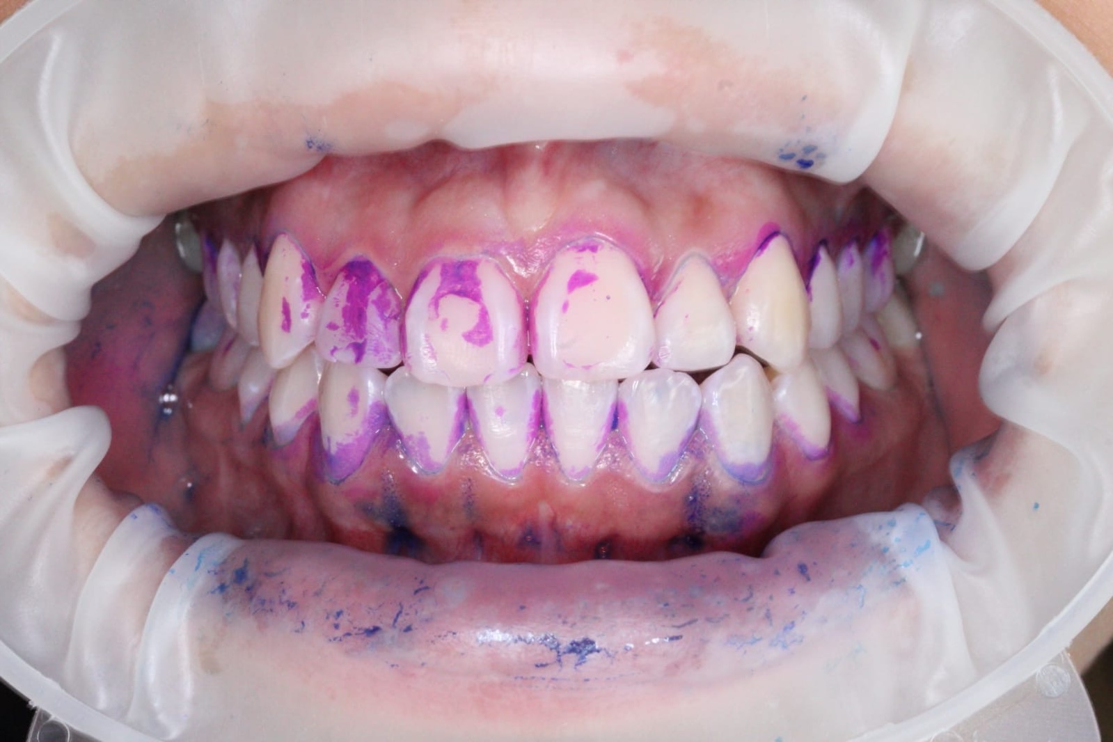 Limpieza dental profesional